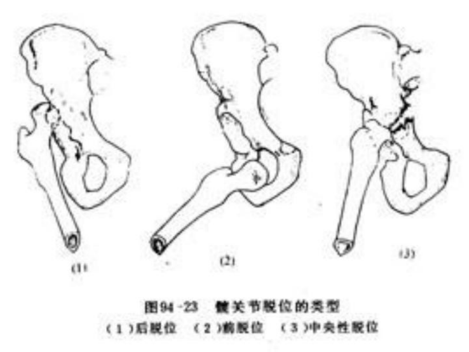 下肢骨、关节损伤讲义课件.ppt_第3页