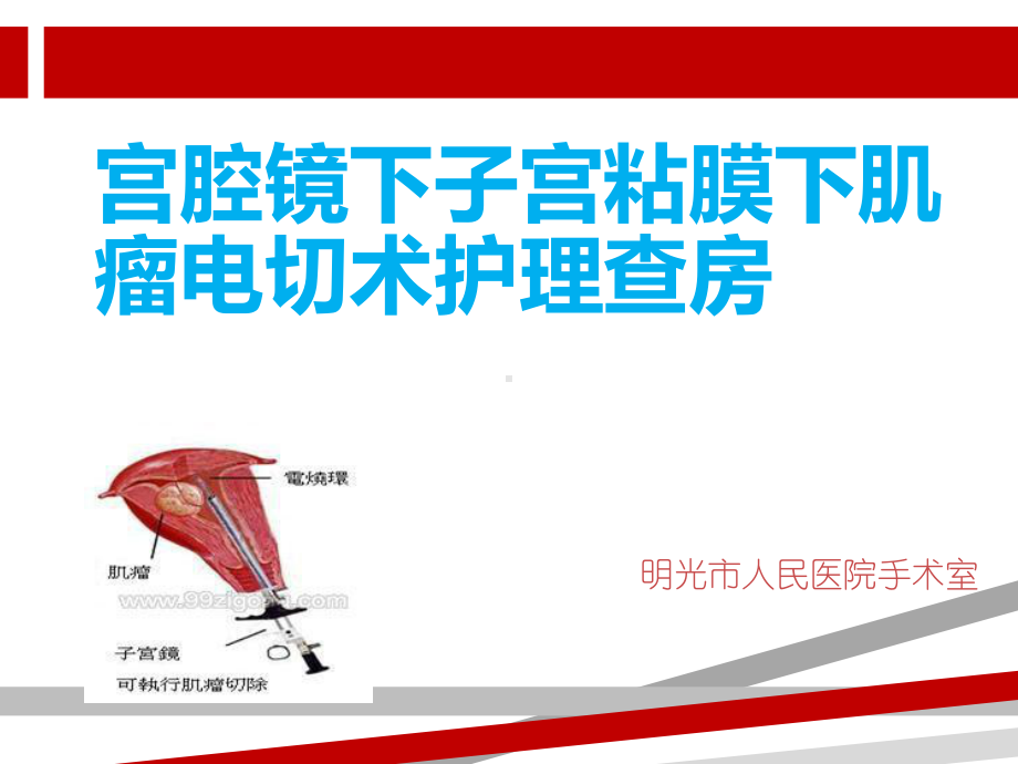 宫腔镜手术的手术配合及护理PPT课件.ppt.ppt_第1页