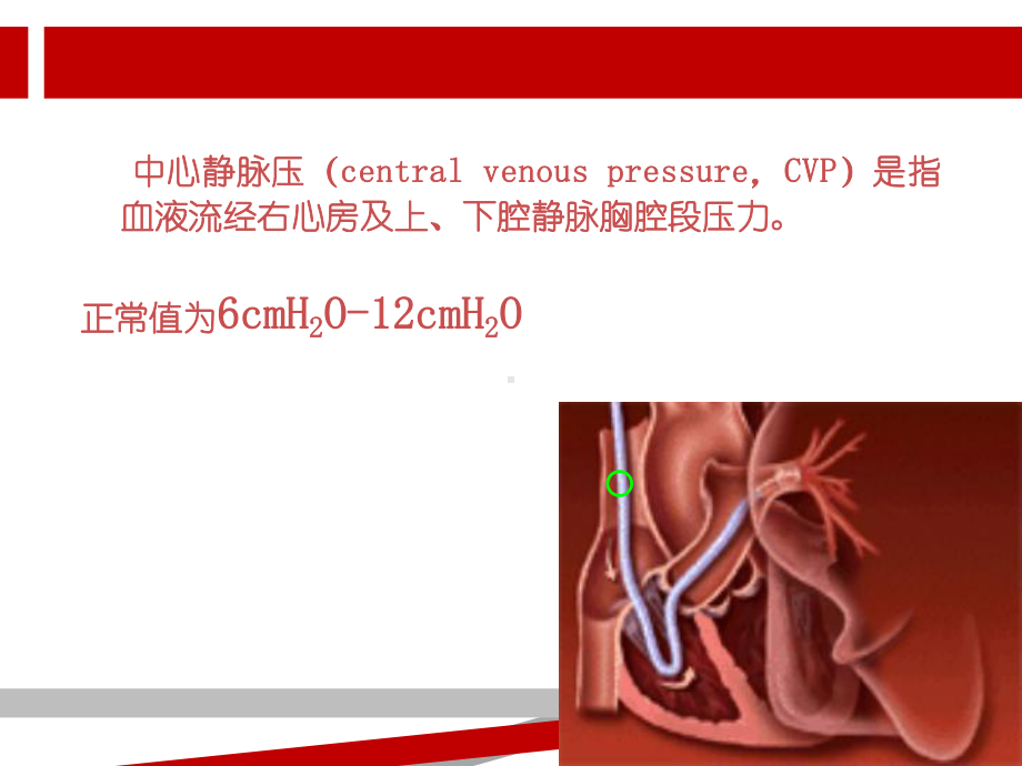 中心静脉压CVP监测.ppt课件.ppt_第2页