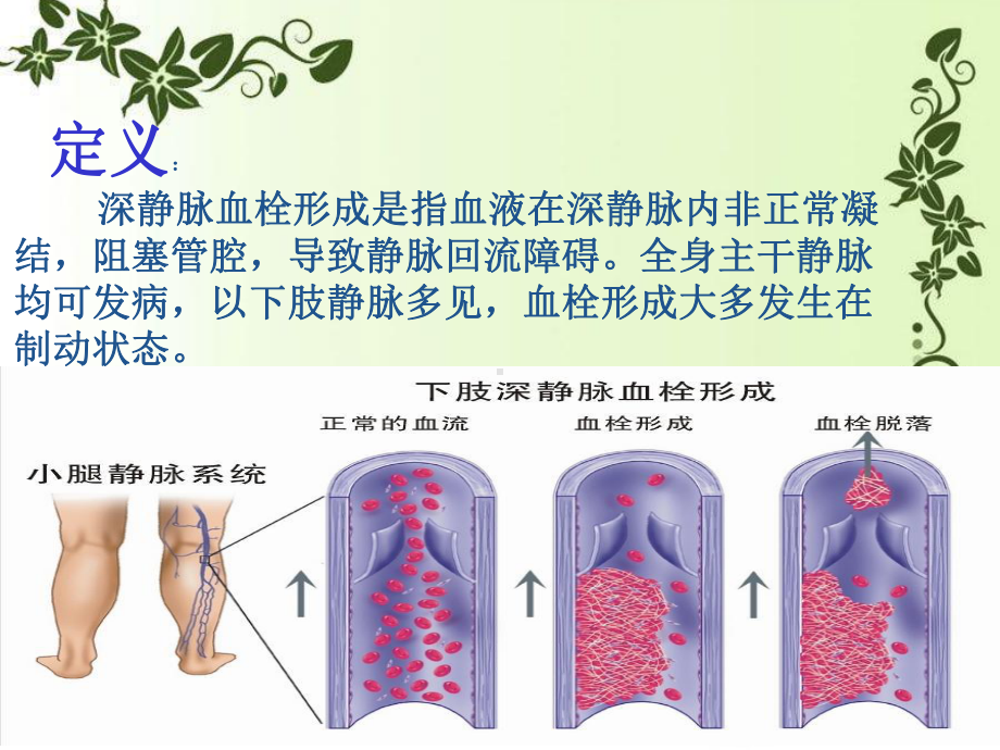 左下肢静脉血栓的疑难病例讨论课件.pptx_第3页