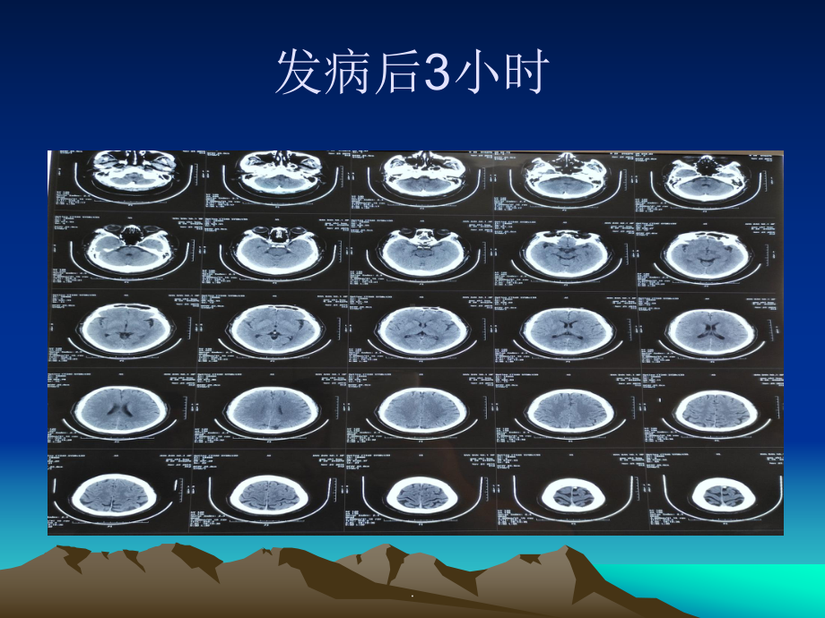 急性脑梗机械取栓PPT课件.ppt_第3页