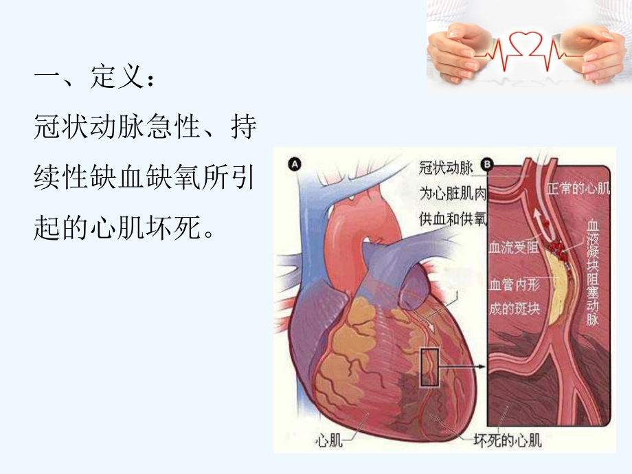 急性心肌梗死急救流程课件.ppt_第2页