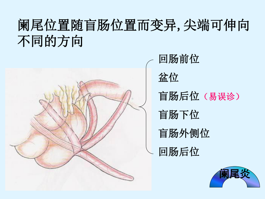 急性阑尾炎患者的护理-PPT课件.ppt_第3页