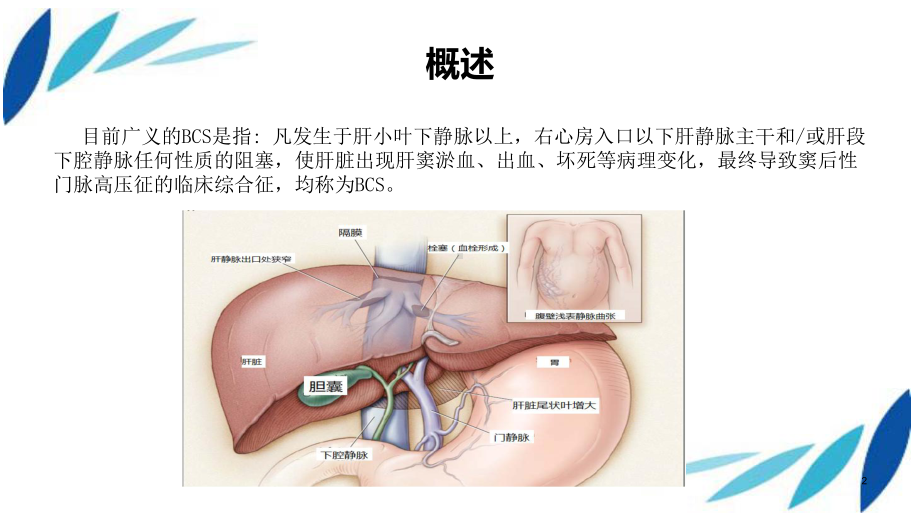 布加综合征ppt演示课件.pptx_第2页