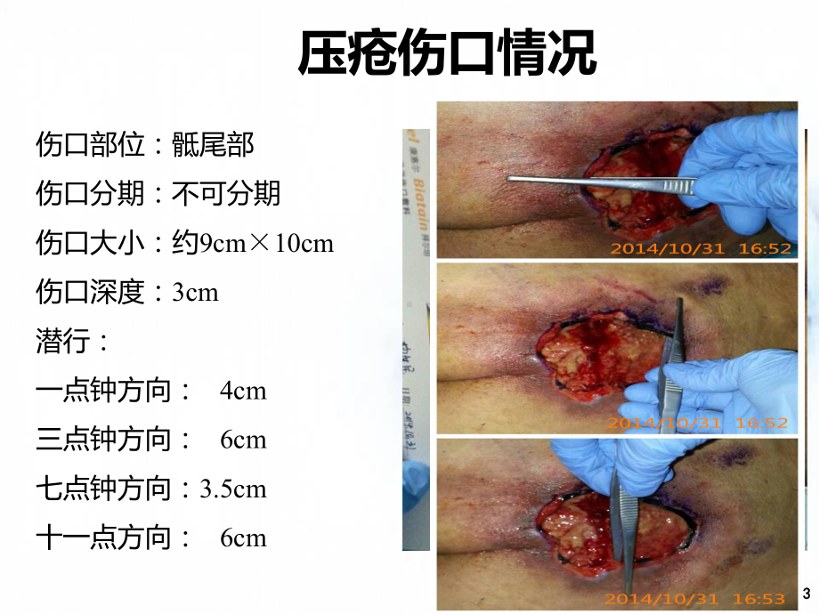 压疮病例汇报PPT幻灯片课件.ppt_第3页