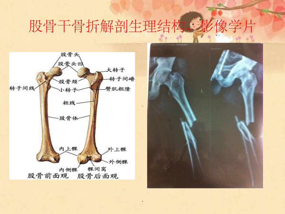 股骨骨折护理查房ppt课件.ppt_第3页