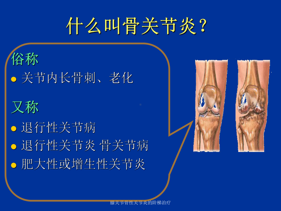 膝关节骨性关节炎的阶梯治疗-ppt课件.ppt_第3页