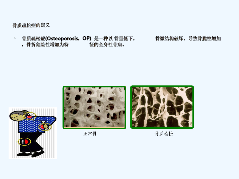 骨质疏松症治疗和护理进展课件.ppt_第2页