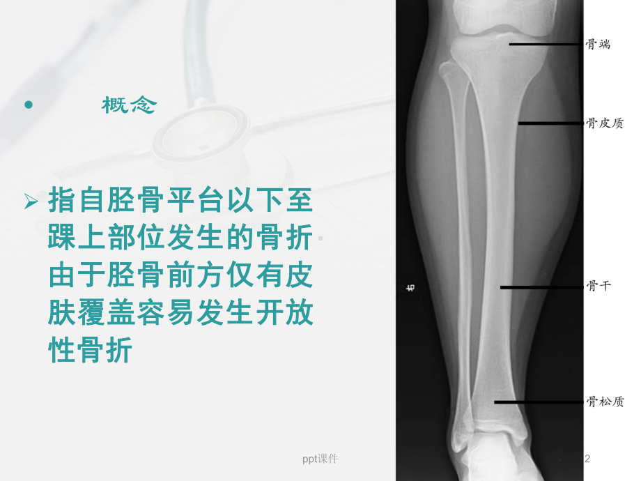 胫腓骨骨折的疾病分析-ppt课件.ppt_第2页