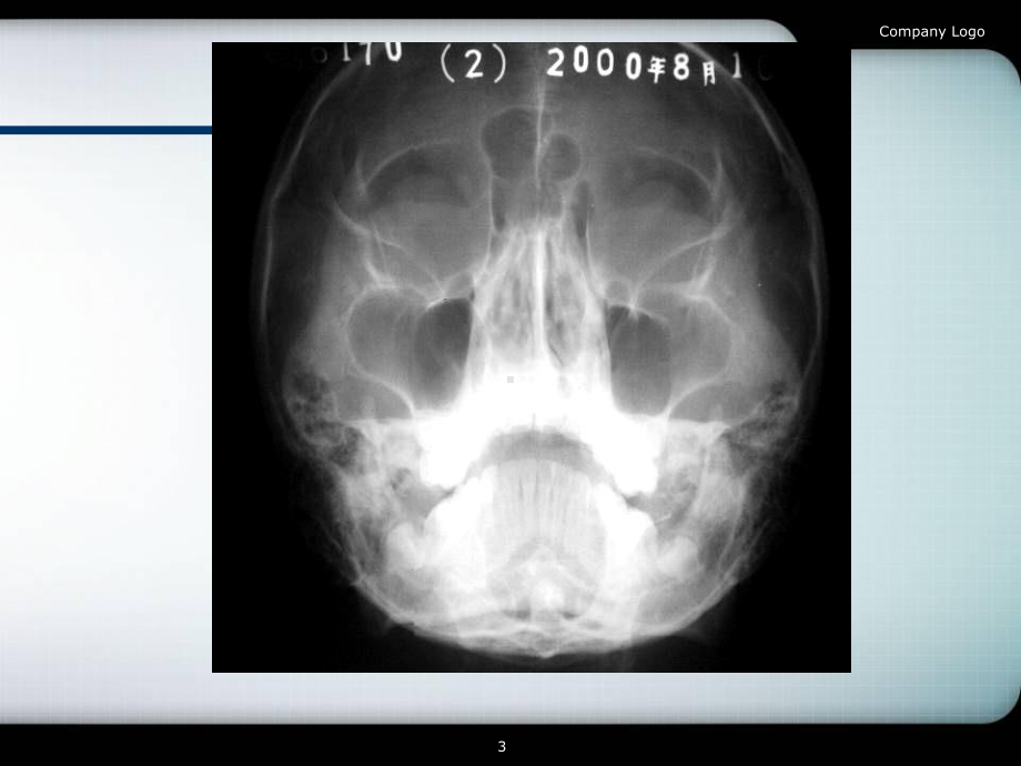 颌面骨折ppt课件.ppt_第3页