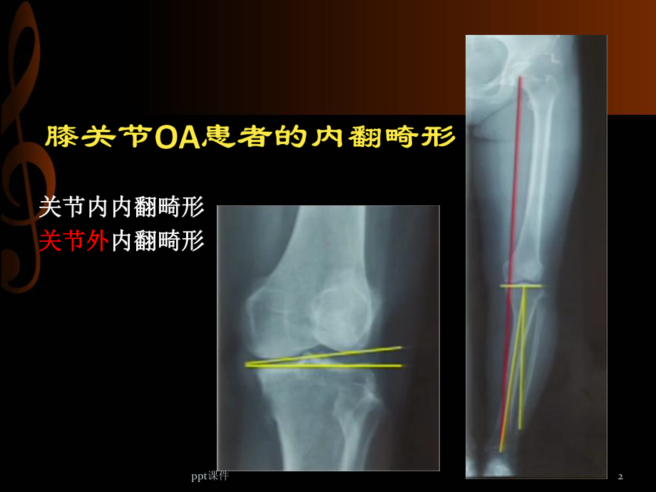 HTO治疗膝关节骨性关节炎-ppt课件.pptx_第2页