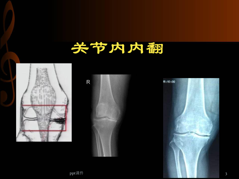 HTO治疗膝关节骨性关节炎-ppt课件.pptx_第3页