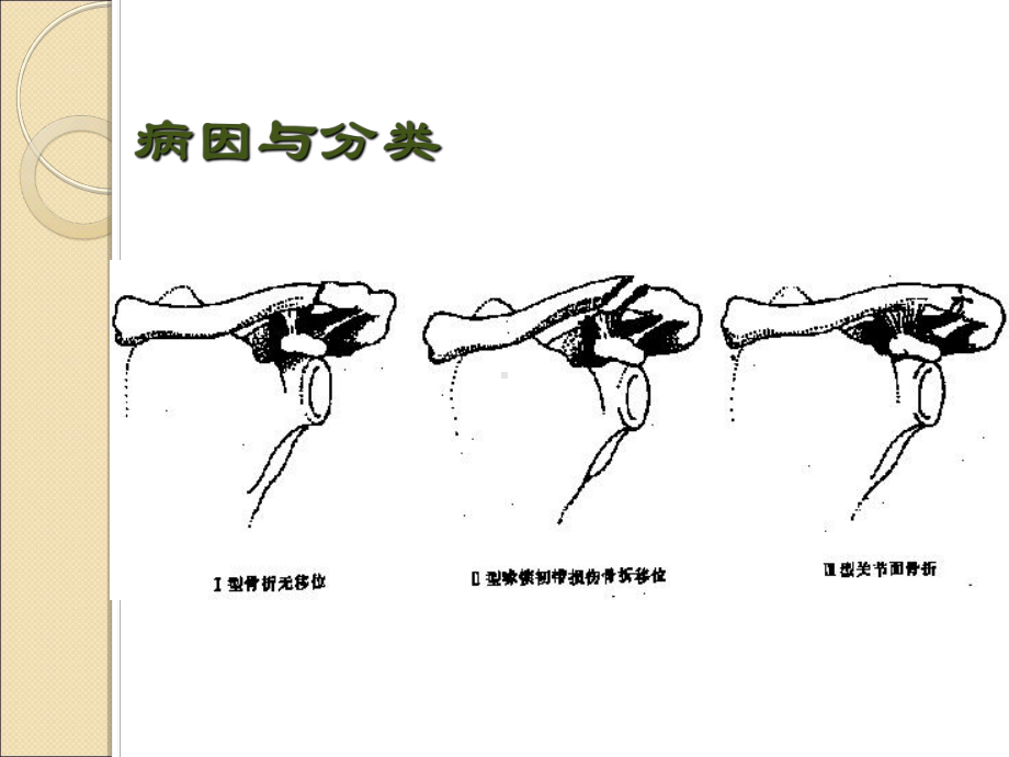 哈尔滨科大学肿瘤外科学上肢骨关节损伤课件.ppt_第3页