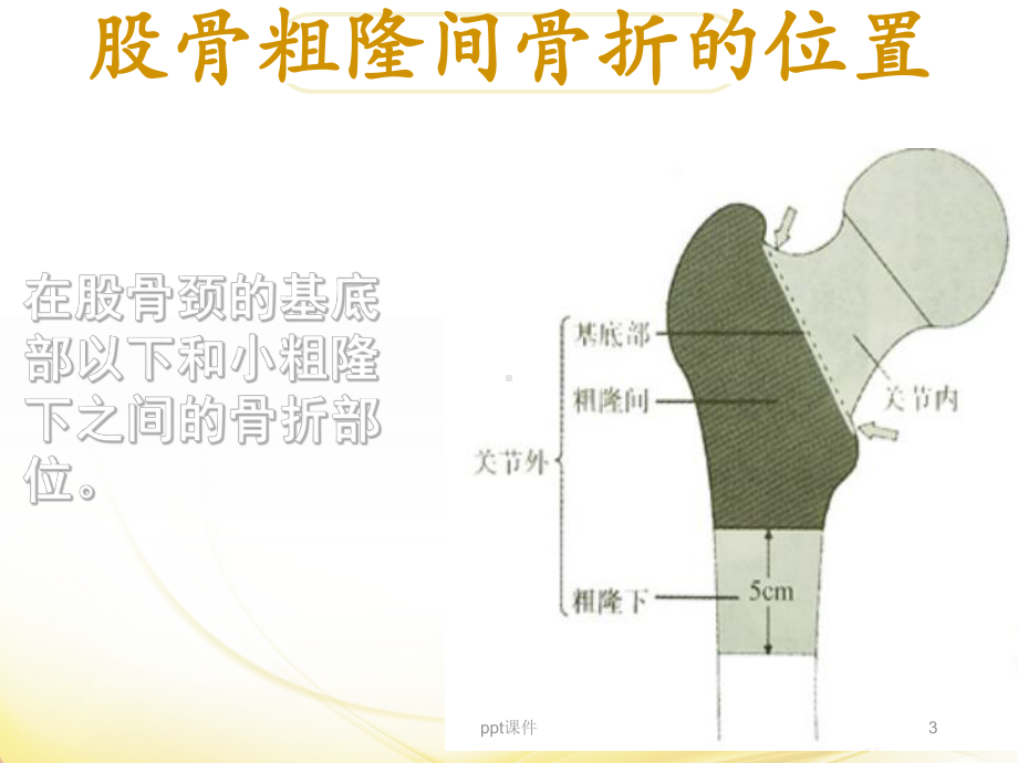 股骨粗隆间骨折术护理查房-ppt课件.ppt_第3页