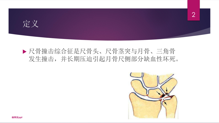 尺骨撞击综合征医学幻灯片课件.pptx_第2页