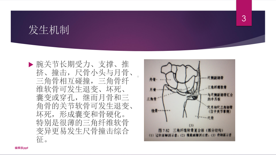 尺骨撞击综合征医学幻灯片课件.pptx_第3页