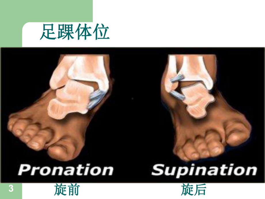 踝关节骨折与脱位的诊治PPT课件.ppt_第3页