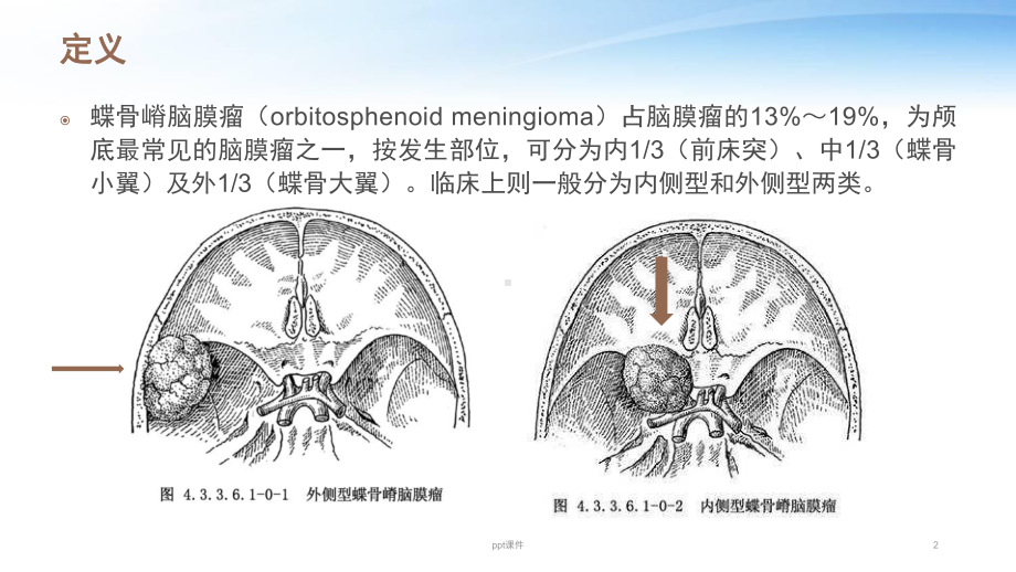 蝶骨嵴脑膜瘤护理查房-ppt课件.pptx_第2页