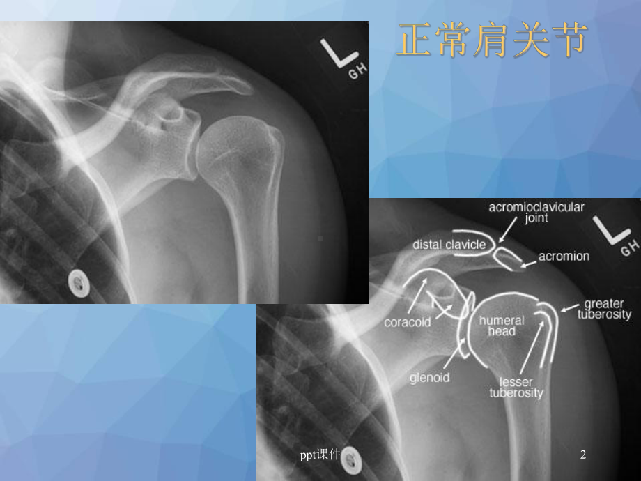 骨折脱位X线表现ppt课件.ppt_第2页