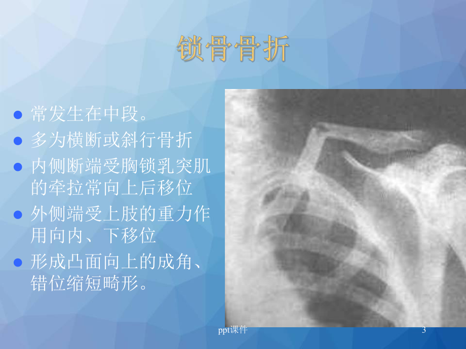 骨折脱位X线表现ppt课件.ppt_第3页