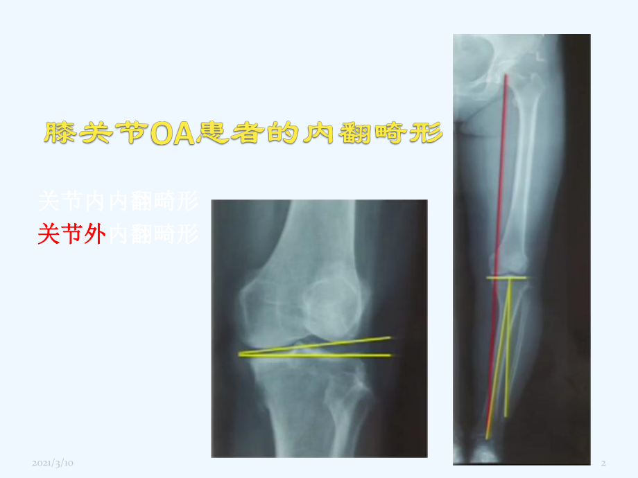 胫骨高位截骨治疗膝关节骨性关节炎课件.pptx_第2页