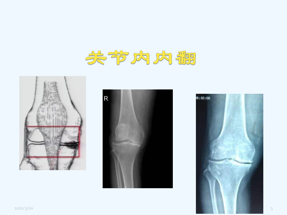 胫骨高位截骨治疗膝关节骨性关节炎课件.pptx_第3页