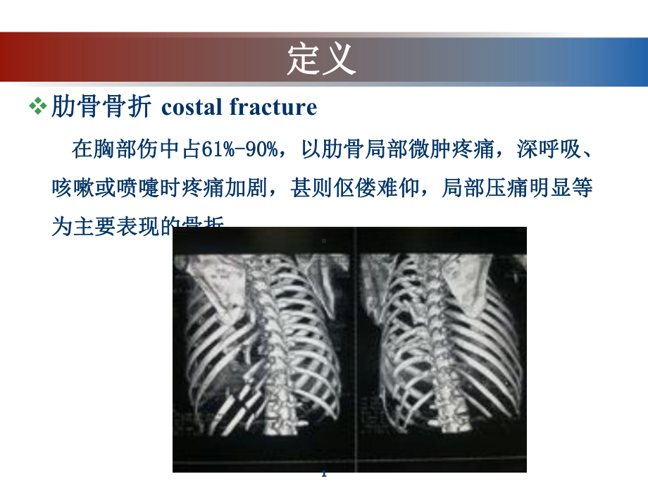 肋骨骨折PPT课件.ppt_第1页