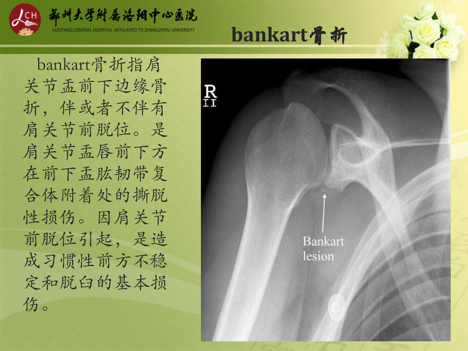 特殊类型骨折课件.ppt_第2页