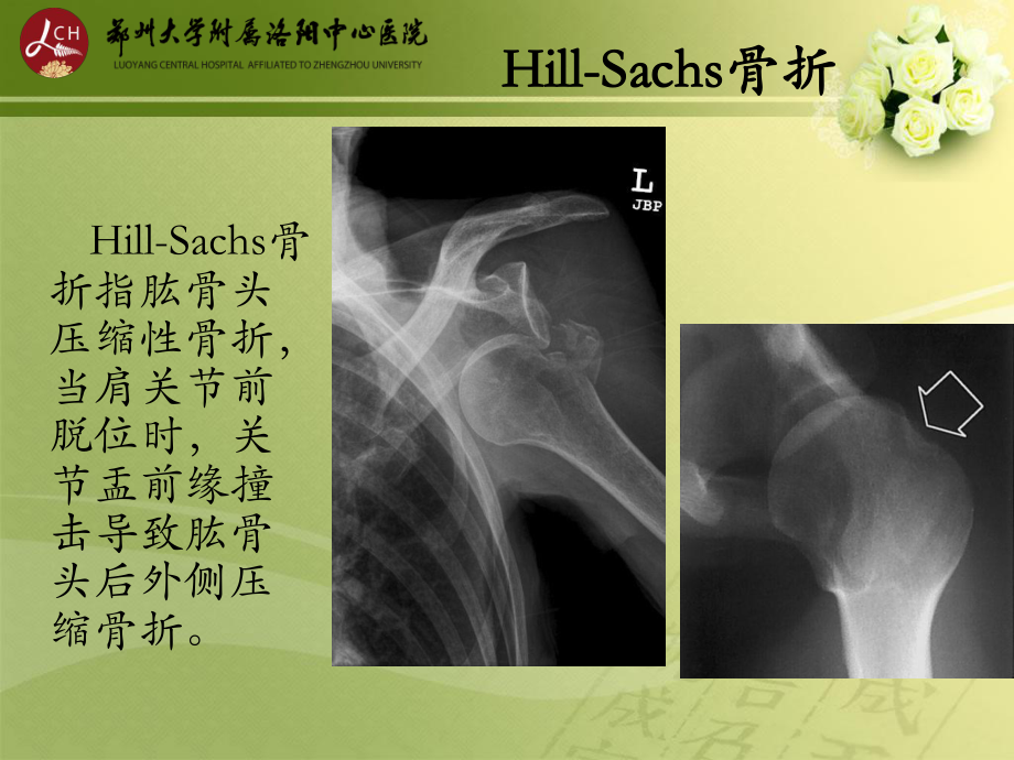 特殊类型骨折课件.ppt_第3页