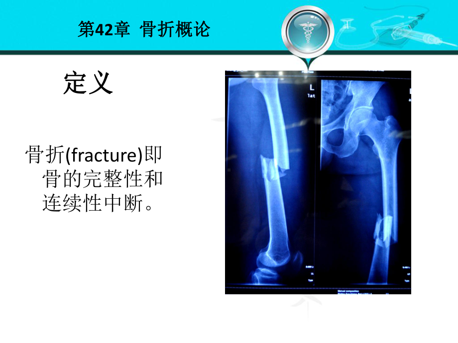 骨折概论-外科学第八版课件.ppt_第2页