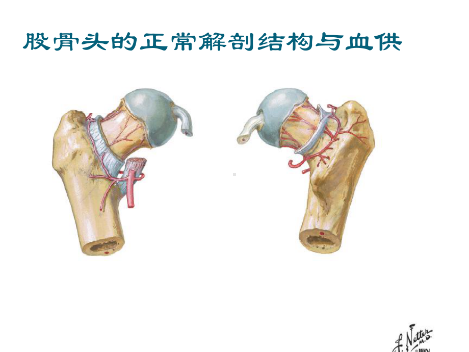 股骨头坏死-巡诊课件.ppt_第3页