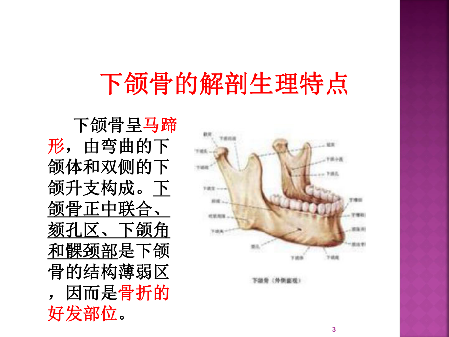 下颌骨骨折的护理查房PPT课件.ppt_第3页