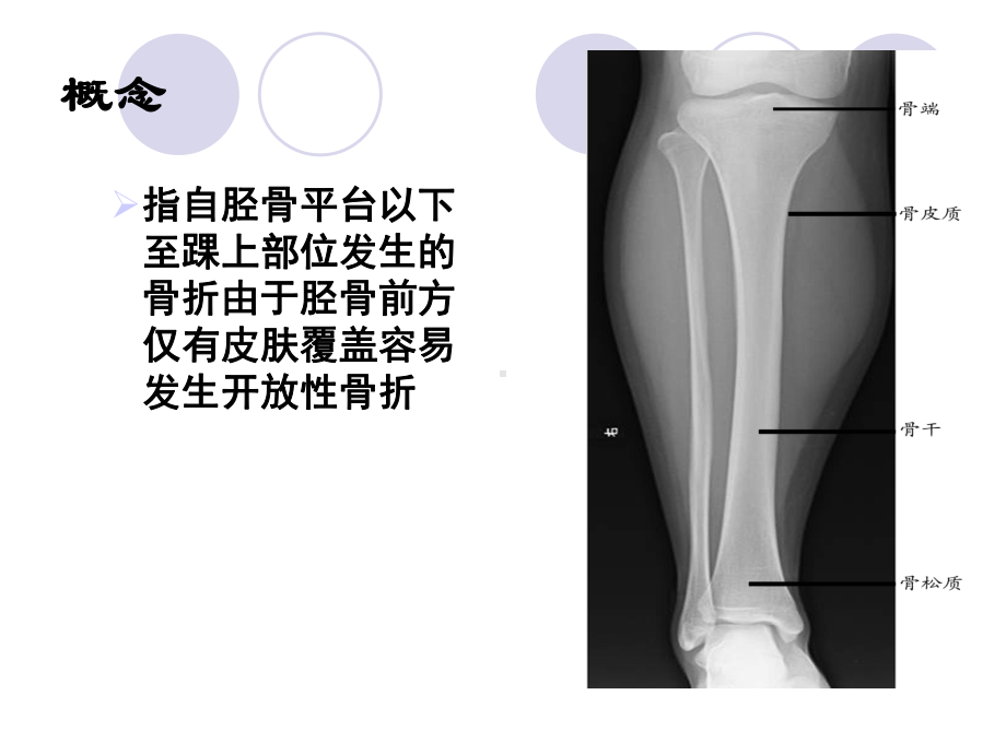 胫腓骨骨折病人的护理课件.ppt_第2页