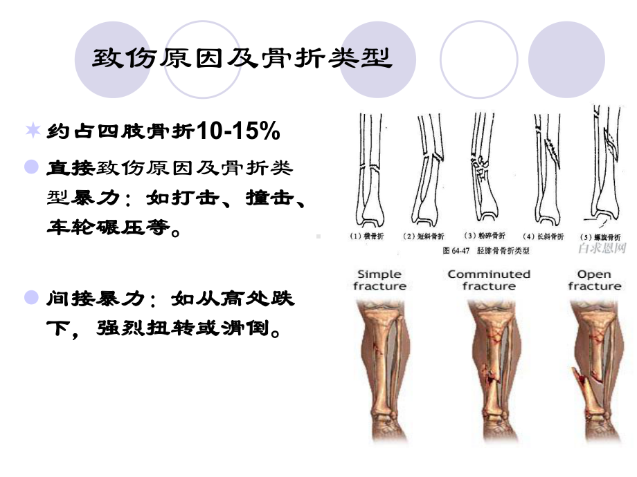 胫腓骨骨折病人的护理课件.ppt_第3页