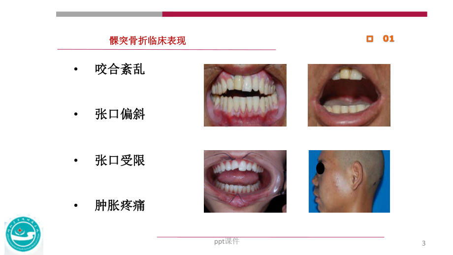 髁突骨折临床诊疗-ppt课件.ppt_第3页