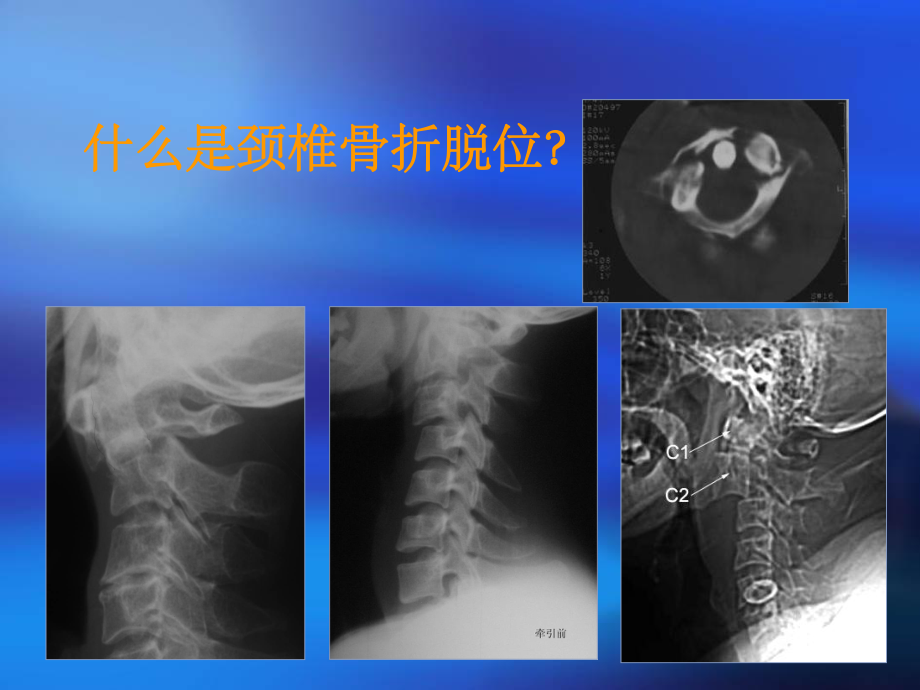 颈椎骨折护理PPT课件.ppt_第3页