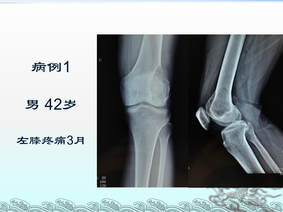 骨巨细胞瘤影像诊断ppt课件.pptx_第2页