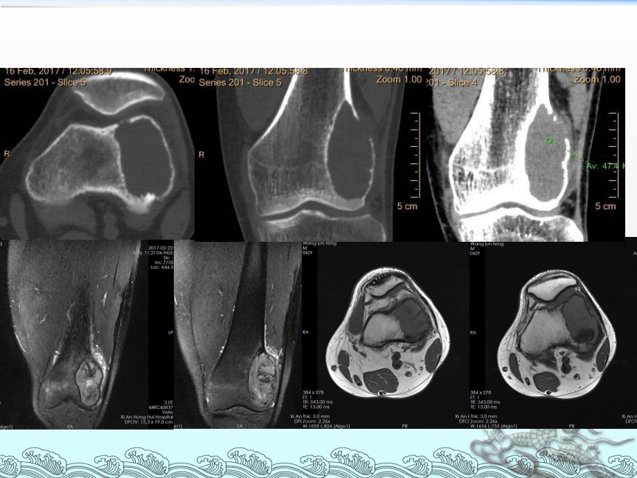 骨巨细胞瘤影像诊断ppt课件.pptx_第3页