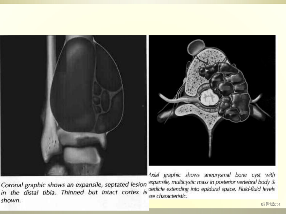 动脉瘤样骨囊肿PPT课件.ppt_第3页