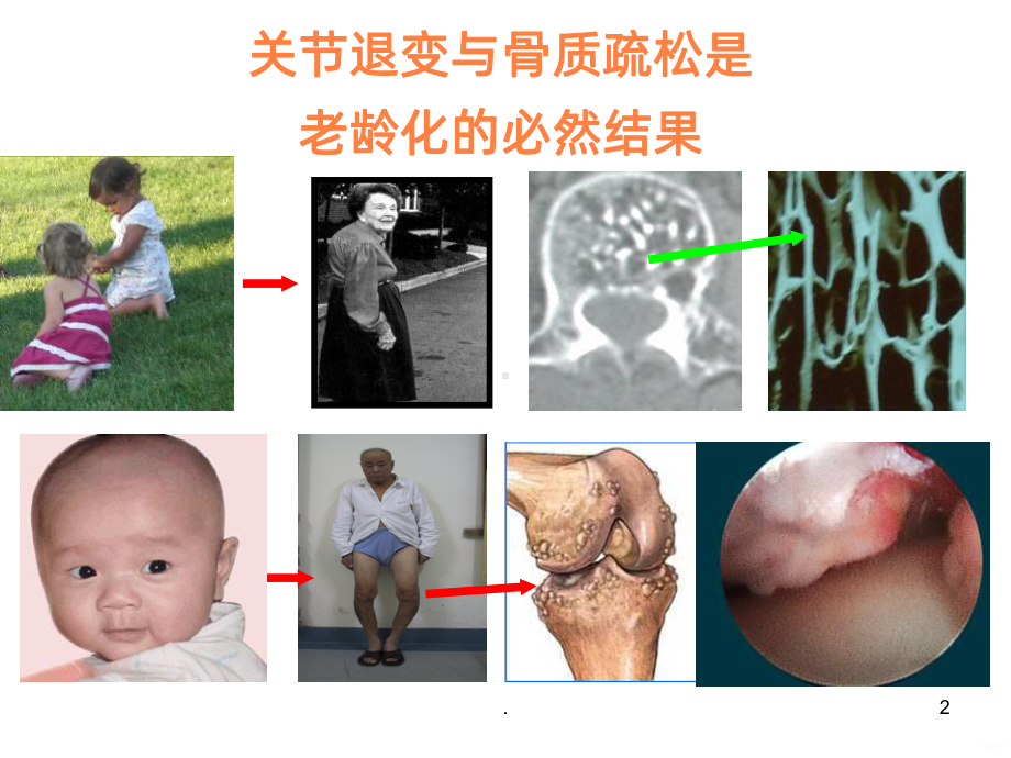 骨关节炎的阶梯治疗ppt课件.ppt_第2页