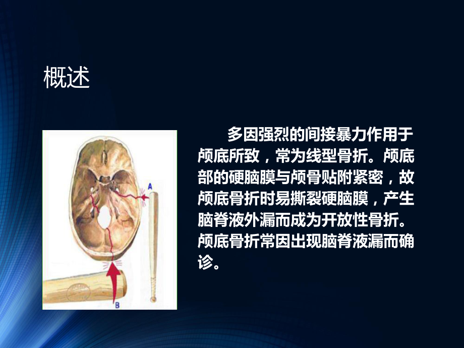 颅底骨折护理PPT课件.ppt_第2页