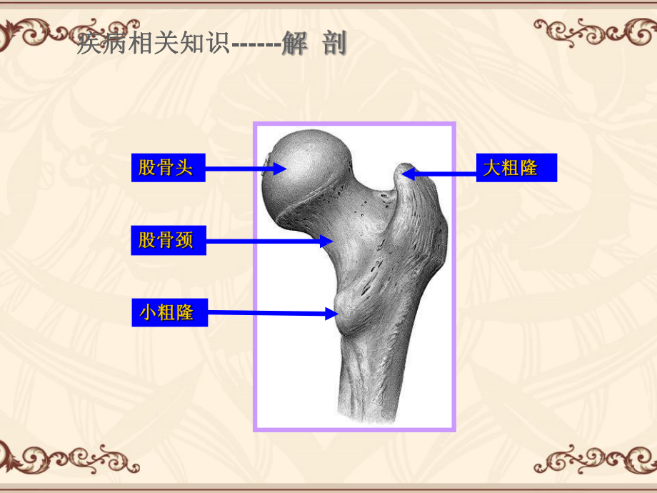 股骨间粗隆骨折护理查房-ppt课件.ppt_第3页