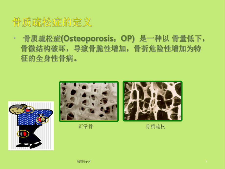 骨质疏松症治疗和护理进展PPT课件.ppt_第2页