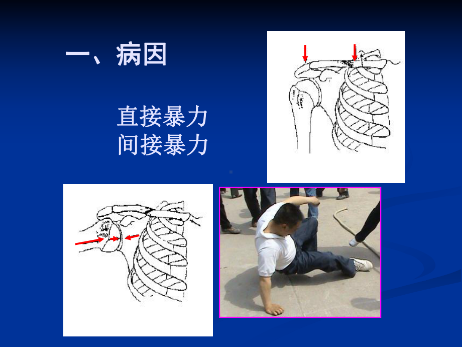 骨科学课件-锁骨骨折-精品.ppt_第2页