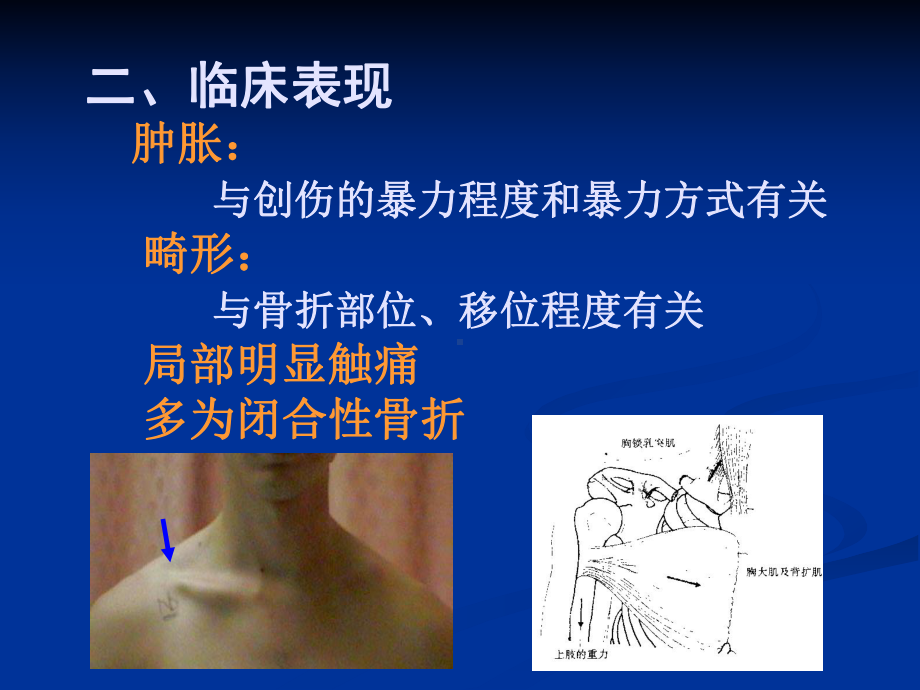 骨科学课件-锁骨骨折-精品.ppt_第3页