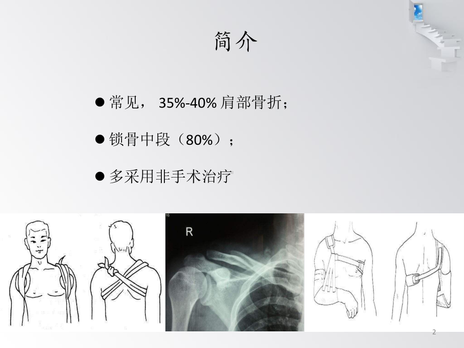 锁骨骨折切开复位内固定PPT课件.ppt_第2页