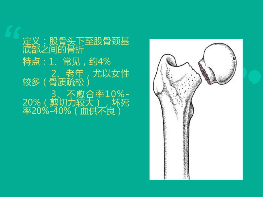 股骨颈骨折-ppt课件1.ppt_第3页