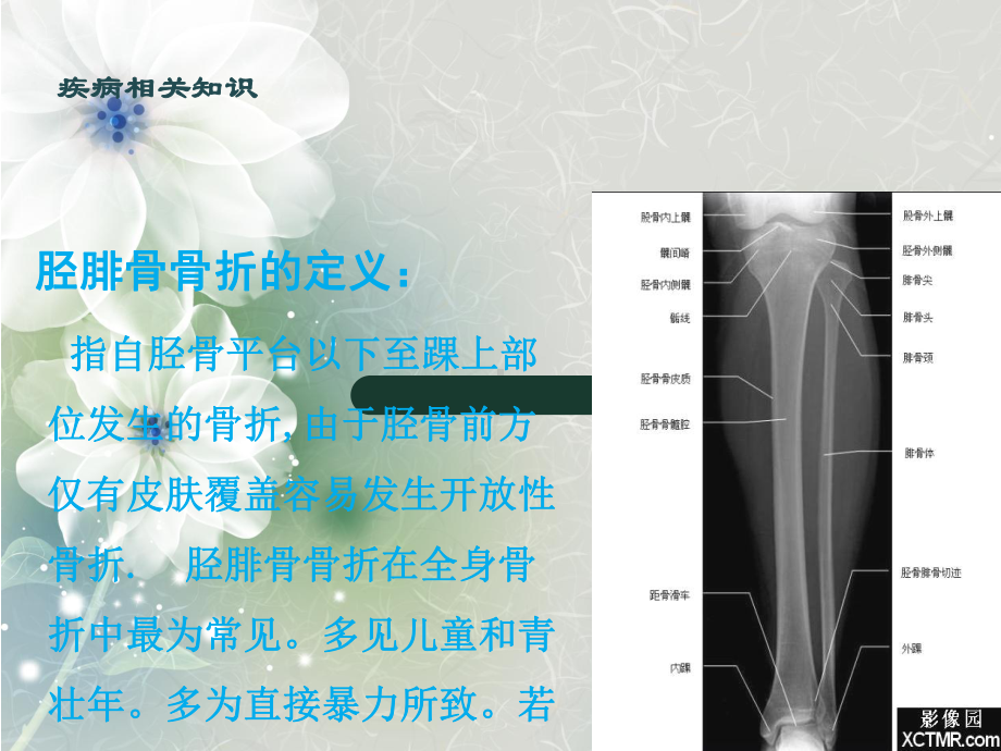 胫腓骨骨折的护理查房课件.ppt_第3页