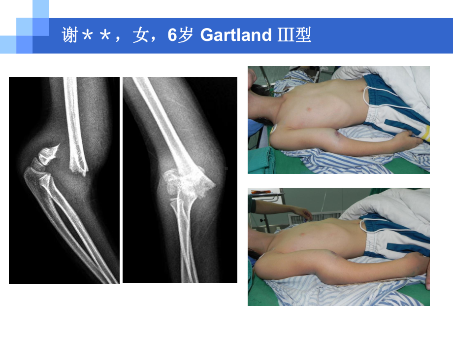 伸直型儿童肱骨髁上骨折PPT课件.ppt_第2页