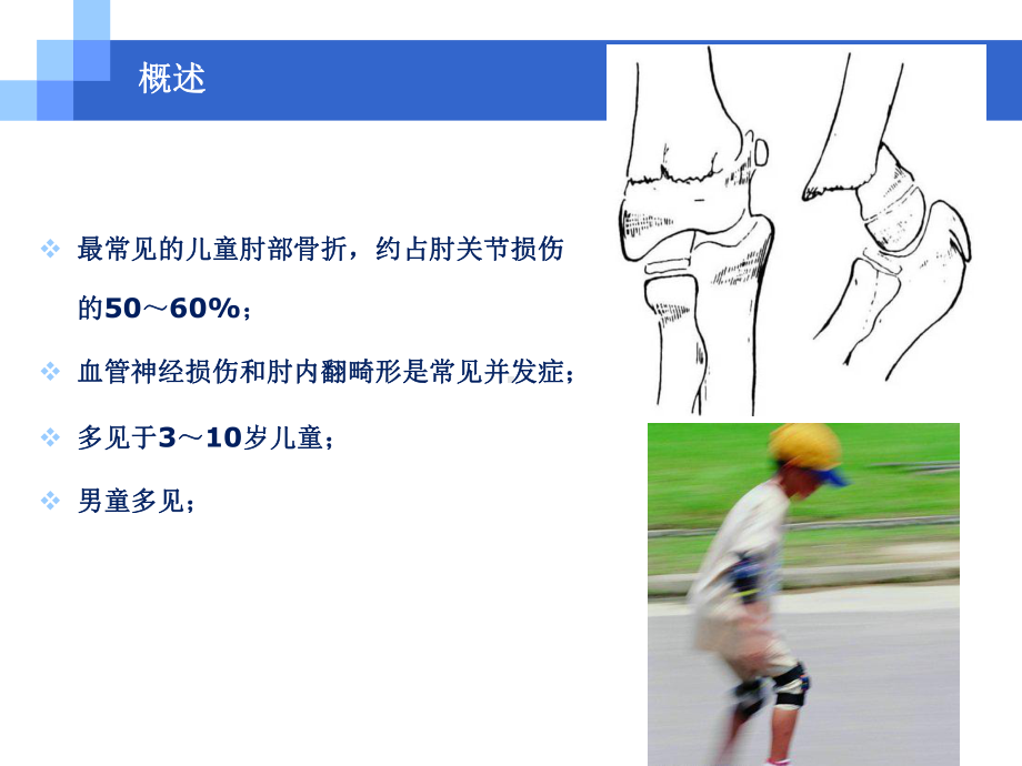 伸直型儿童肱骨髁上骨折PPT课件.ppt_第3页